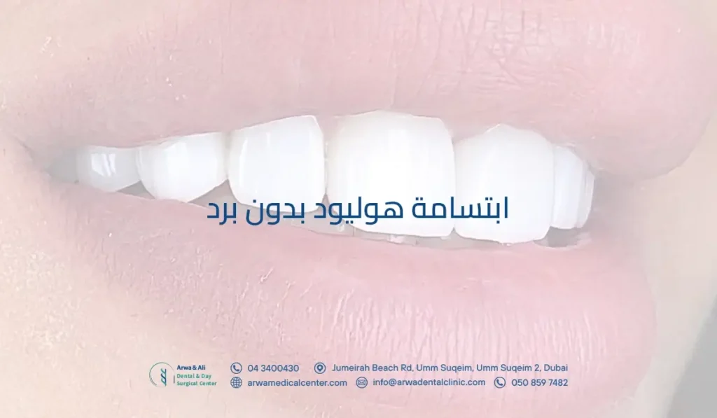 ابتسامة هوليود بدون برد