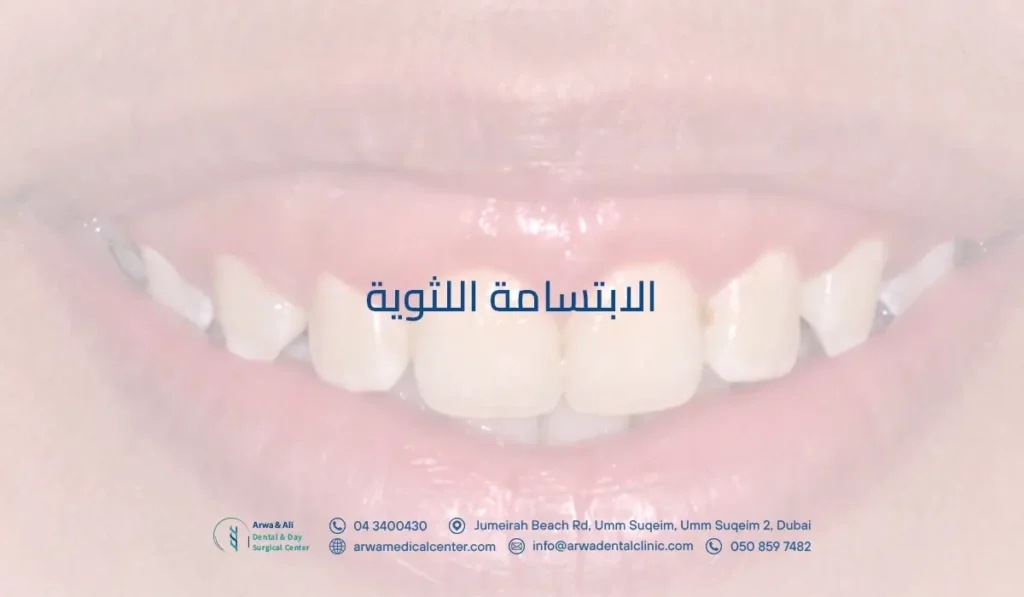 الابتسامة اللثوية