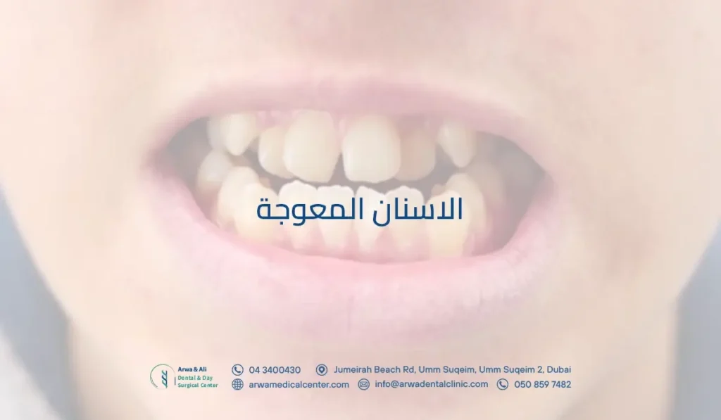 الاسنان المعوجة