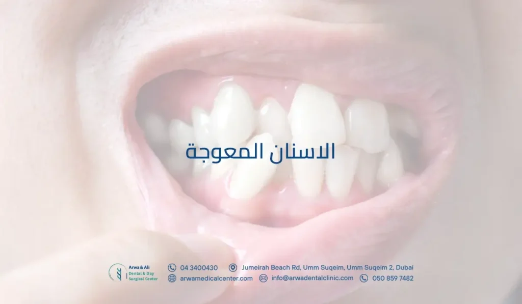 الاسنان المعوجة