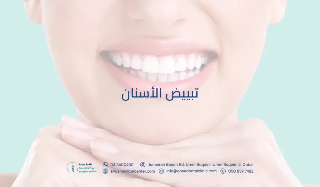 تبييض الأسنان