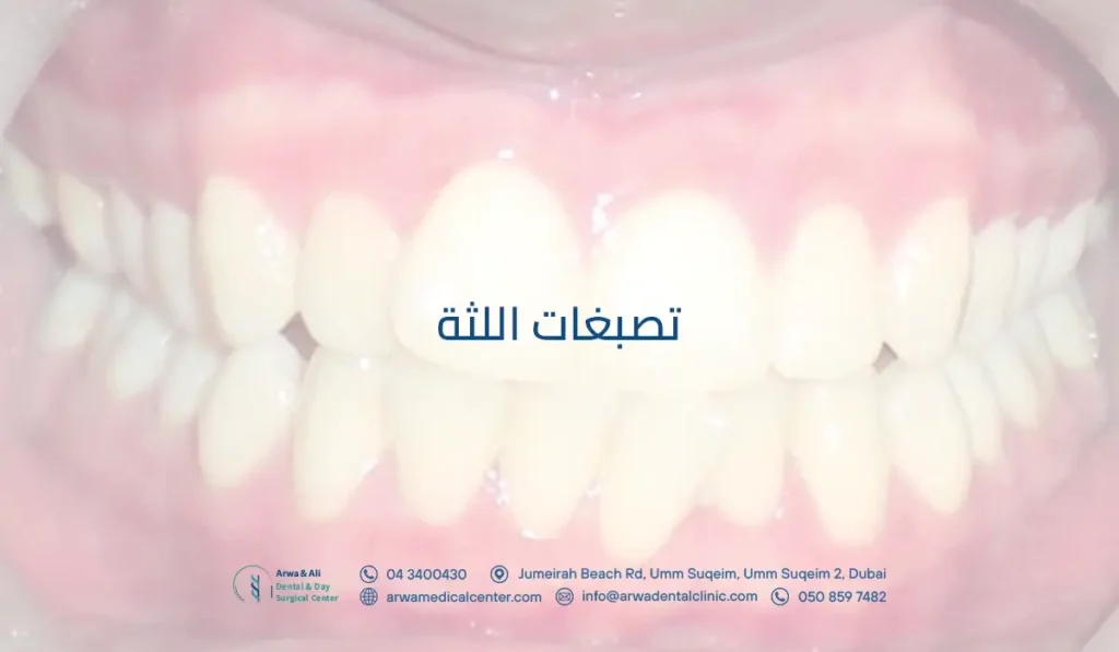تصبغات اللثة