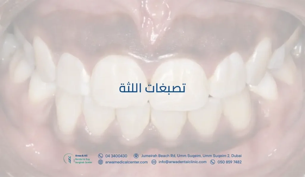 تصبغات اللثة