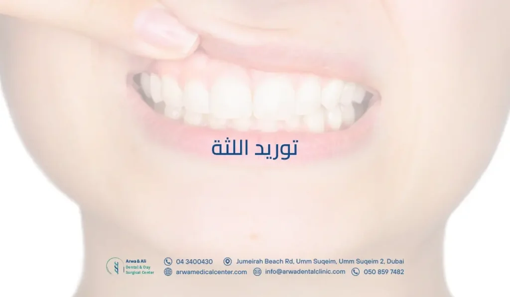 توريد اللثة