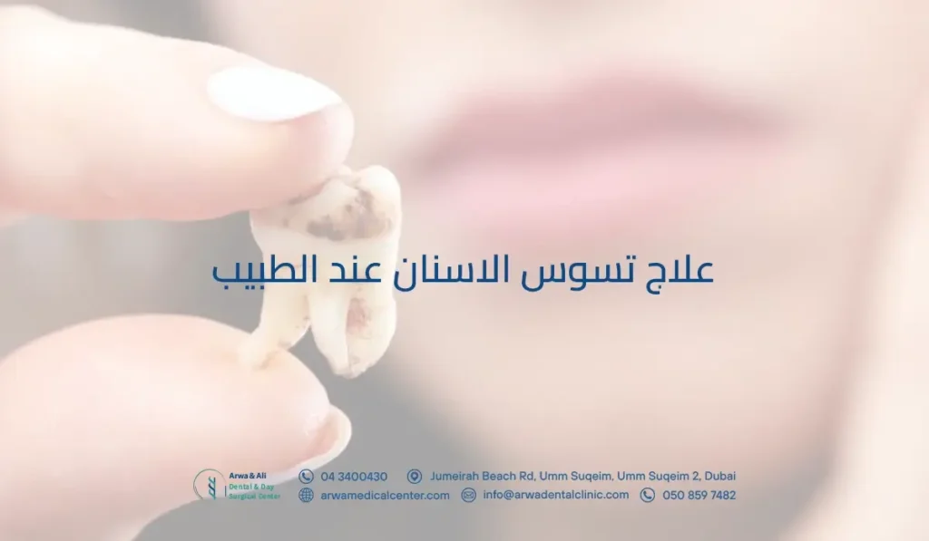 علاج تسوس الاسنان عند الطبيب​