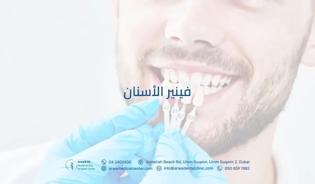 فينير الأسنان