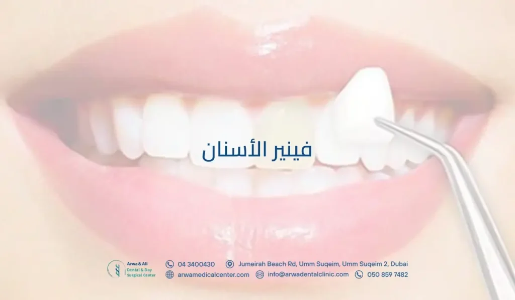 فينير الأسنان