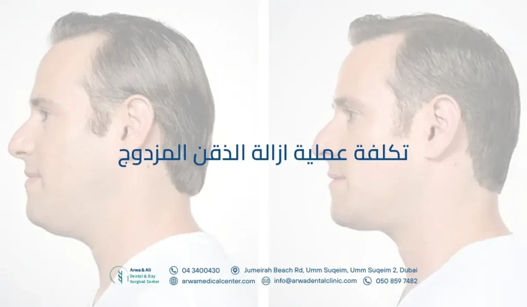 تكلفة عملية ازالة الذقن المزدوج