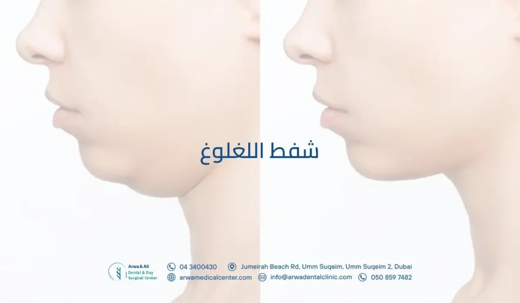شفط اللغلوغ​