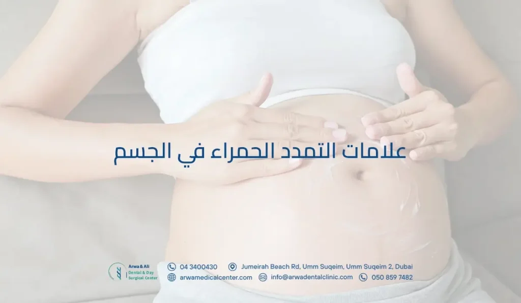 علامات التمدد الحمراء في الجسم