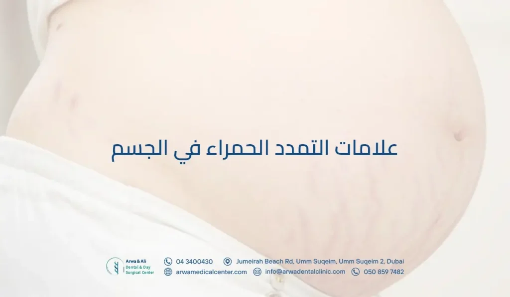 علامات التمدد الحمراء في الجسم