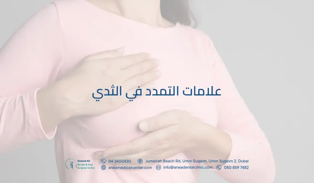 علامات التمدد في الثدي