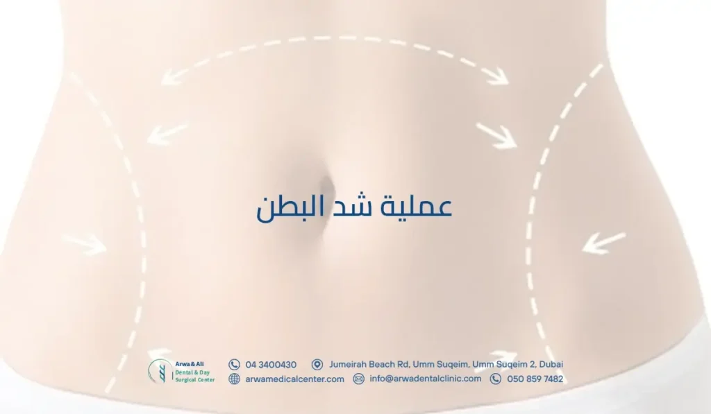 عملية شد البطن