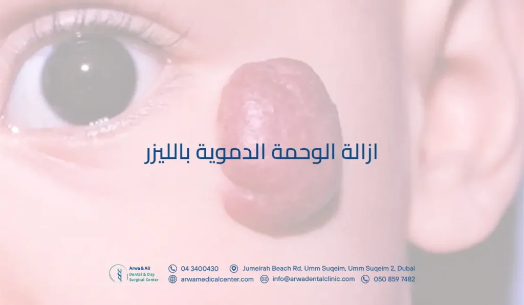 ازالة الوحمة الدموية بالليزر