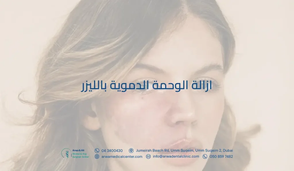 ازالة الوحمة الدموية بالليزر