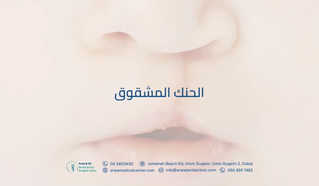 الحنك المشقوق