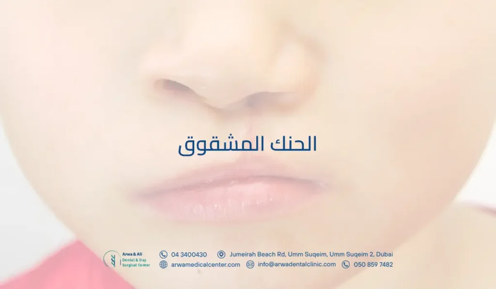 الحنك المشقوق