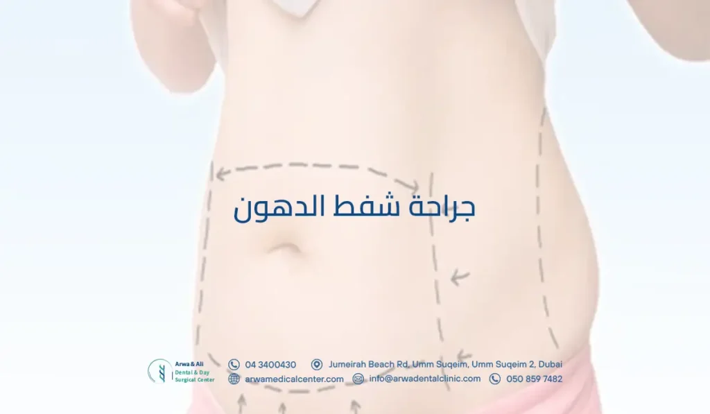 جراحة شفط الدهون