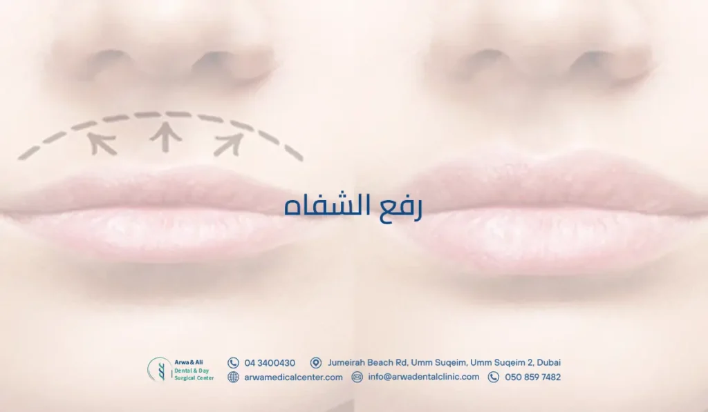 رفع الشفاه