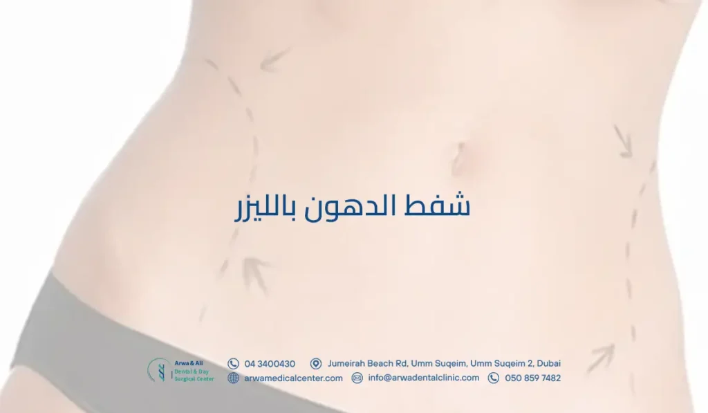شفط الدهون بالليزر