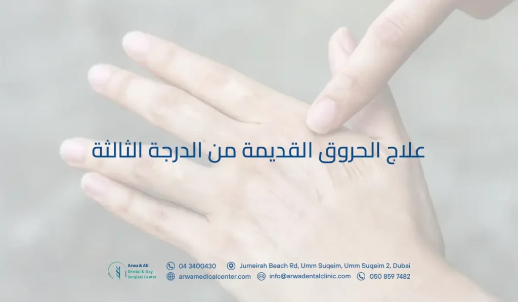 علاج الحروق القديمة من الدرجة الثالثة​