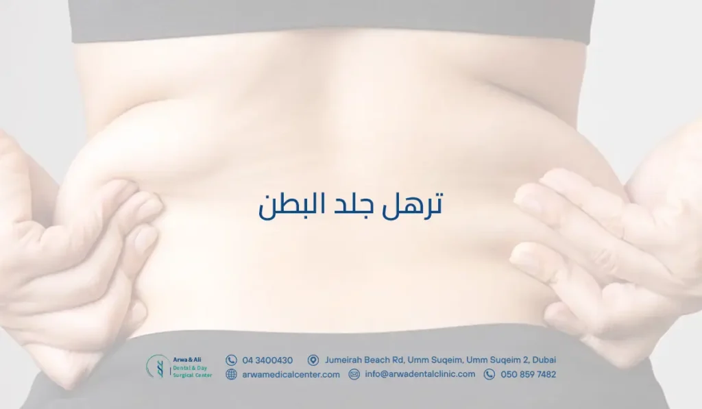 ترهل جلد البطن: ما أنواع ترهلات البطن؟ وما درجات ترهل البطن المختلفة؟ 3 ترهل جلد البطن