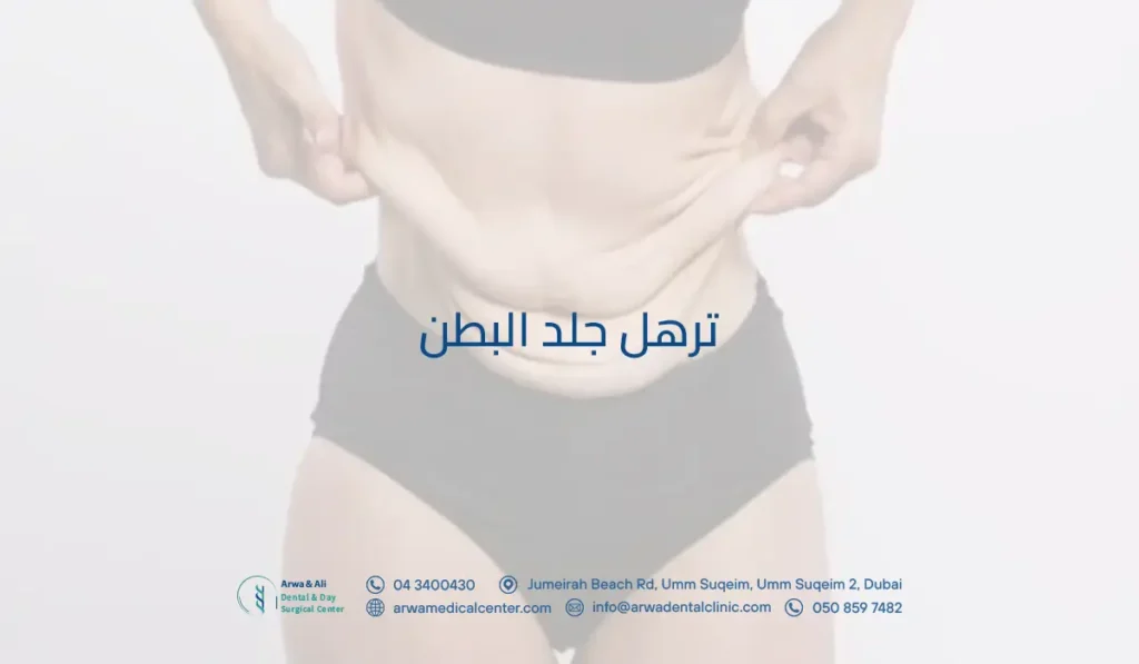 ترهل جلد البطن​